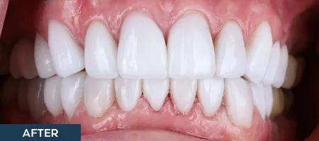 Close up of smile with whiter restored teeth