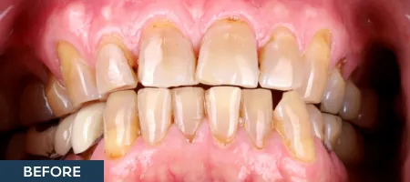 Close up of smile with yellowed, damaged teeth