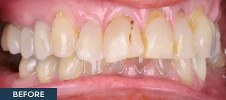 Smile with unhealthy teeth and gum recession