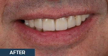 Smile after correction of severe discoloration