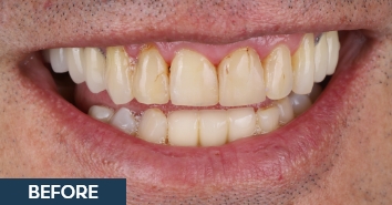 Smile before and after correction of severe discoloration