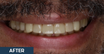 Smile after correction of severe discoloration