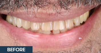 Smile before and after correction of severe discoloration