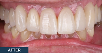 Smile after correction of severe discoloration