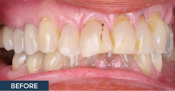 Smile before correction of severe discoloration