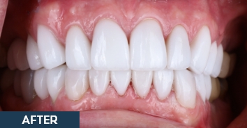 Smile after correction of severe discoloration