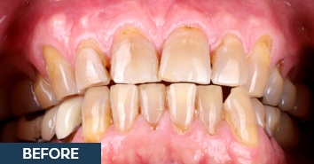Smile before correction of severe discoloration