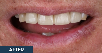 Smile after placing veneers to fix damaged teeth