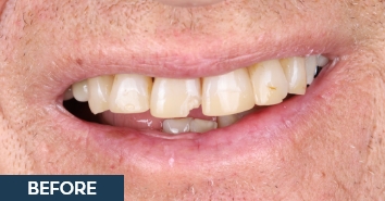 Smile before placing veneers to fix damaged teeth